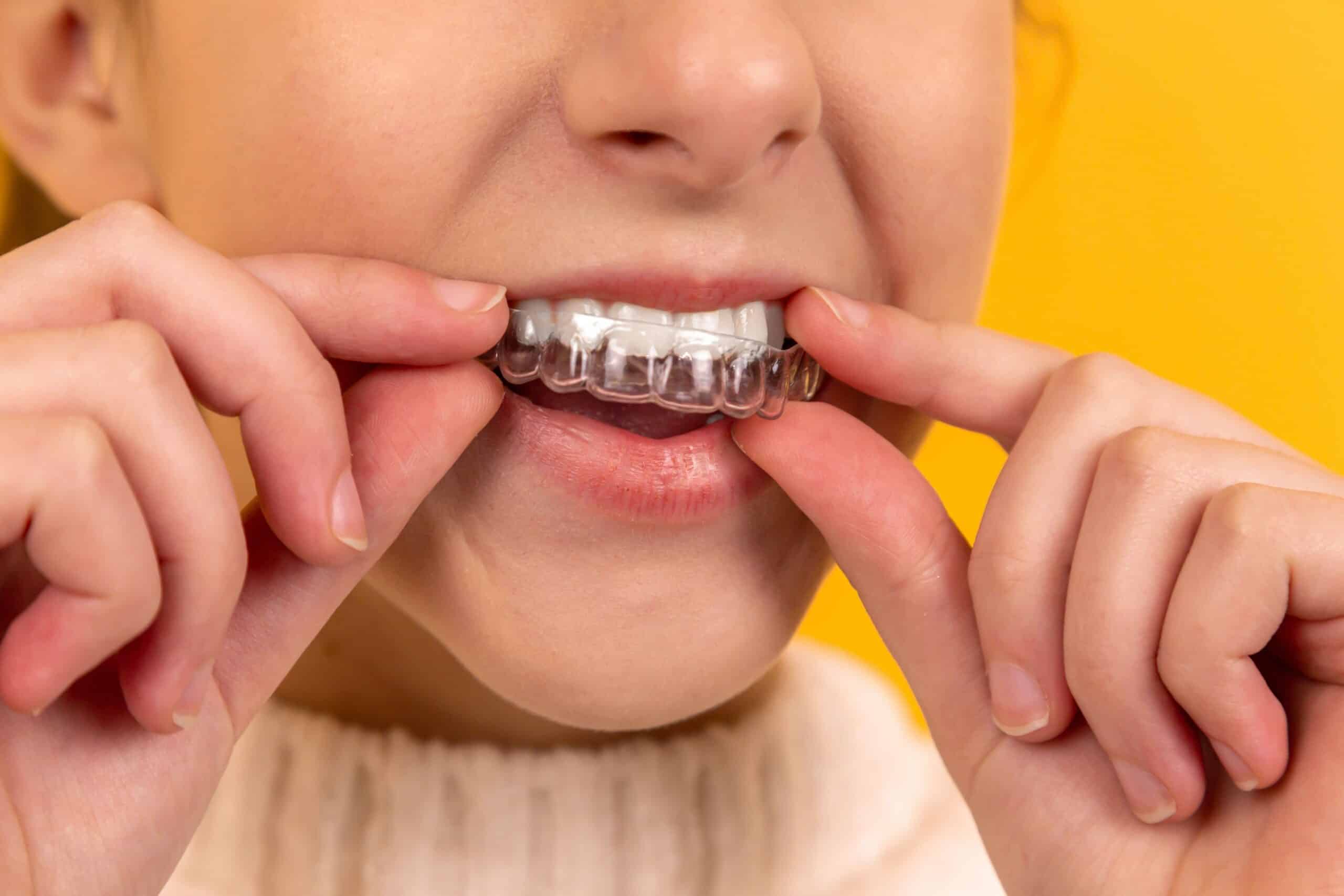 mouthguard