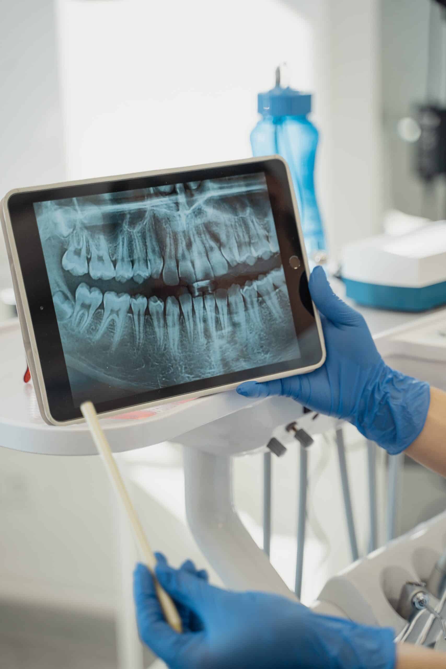 root_canal
