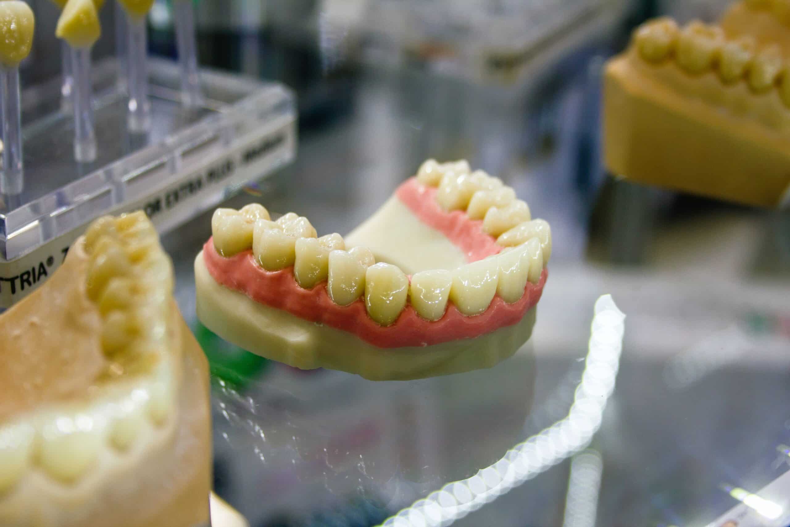 white_composite_fillings